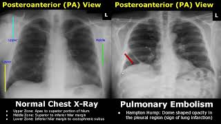 Chest XRay Lung Normal Vs Abnormal Image Appearances Part 2  Pleural EffusionPneumothorax PA CXR [upl. by Martainn]