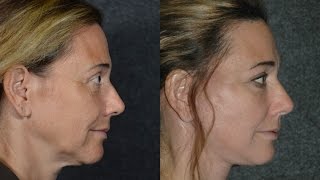 Facelift Surgery SLift on 50YearOld Woman  Ponytail Technique Facelift ponytailfacelift [upl. by Hines]