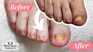 Pedicure Beauty Series Rams Horn Toenail Transformation [upl. by Etnahs]