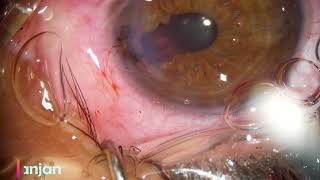 Corneal Laceration Repair [upl. by Yle]