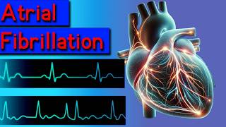 Atrial fibrillation symptoms causes risks and treatment [upl. by Tcideneb625]