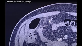 Omental infarction  CT findings [upl. by Zachariah]