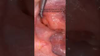 TONSIL STONES REMOVAL VIDEOS  TONSILOLITOS MAL ALIENTO COMO QUITARLO 👈😭 odontologia shorts [upl. by Win]