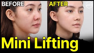 Best Bang for Your Buck See the Changes After Mini Lifting  AB Plastic Surgery [upl. by Llerrahs]