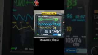 VPC In ECG venticular ectopic heartknowledge cathlab ytshorts ecg [upl. by Hungarian]