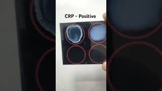 CRP test procedure  CReactive Protein  crp test kaise kiya jata hai  medical pathology [upl. by Eserahs]