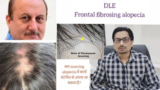 Scarring Alopecia  Lichen planopilaris  DLE  Frontal fibrosing alopecia alopecia lpp dle FFA [upl. by Nolyk]