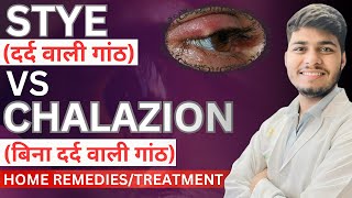 Stye vs chalazion  Difference between stye and chalazion [upl. by Yasmine762]