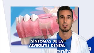 TRATAMIENTO de la ALVEOLITIS y SÍNTOMAS de la infección tras extracción de muela  Shorts [upl. by Weywadt307]