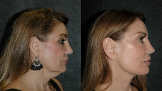 Deep Plane Facelift Before and After  Best Facelift Surgeon deepplanefacelift [upl. by Annej]