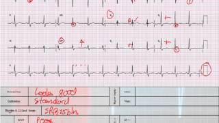 12 Lead Interpretation Part 41 Bundle Branch and Fascicular Blocks [upl. by Cynar630]