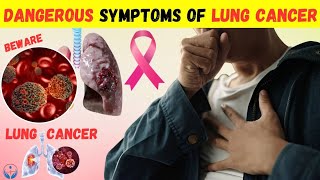 Dangerous Symptoms of lung cancer [upl. by Marie]