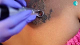 Safe and Quick Laser Tattoo Removal Treatment [upl. by Geddes]