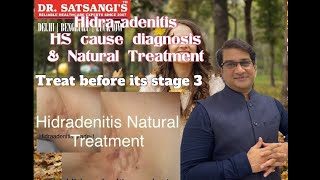 Hidradenitis suppuritiva Tips for Boils Bumps HS Self Care  Curing HS Natural Dr Manish Satsangi [upl. by Reemas807]