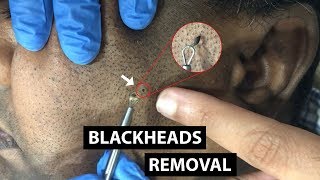 Blackheads  Whiteheads Extraction  ZI Clinic [upl. by Arman321]