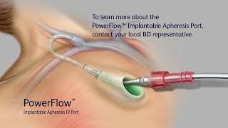 PowerFlow Implantable Apheresis IV Port Access Video [upl. by Killy]