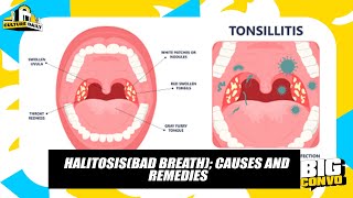 Halitosis Causes Effects And It’s Treatment [upl. by Gefell]