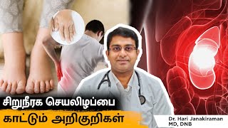 Kidney Failure Symptoms in Tamil  Warning Signs and Symptoms of Kidney Disease Salem Gopi Hospital [upl. by Attenal]