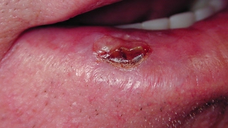 Carcinome basocellulaire  Basocellular carcinoma Galerie photo  Photo gallery [upl. by Rambort]