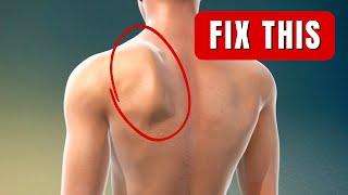 How to Fix Your Winged Scapula shoulder blade [upl. by Read167]