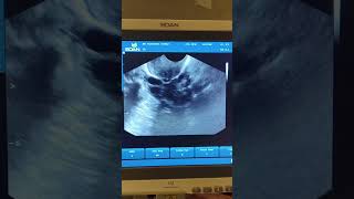 Endometrial Polyp and Ant wall interstitial myoma pregnant 39weekspregnant [upl. by Ydnas]