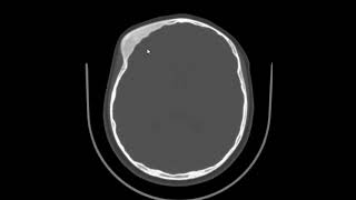 Displasia fibrosa cranio facial [upl. by Neelyk]