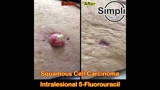 Squamous Cell Carcinoma Intralesional 5Fluorouracil [upl. by Manbahs182]