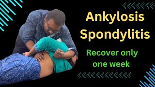 Ankylosis Spondylitis Recover Only One Week ankylosing spondylitis symptoms treating ankylosing [upl. by Barrus]