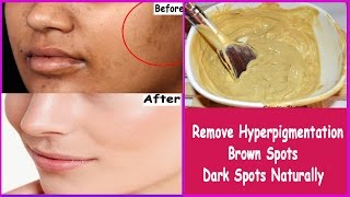 Simple and Easy Home Remedies to reduce Hyperpigmentation Brown Spots Dark Spots or Black Patches [upl. by Atimed950]