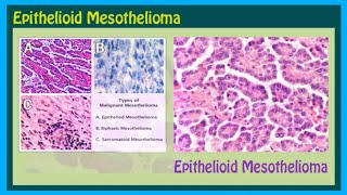 Epithelioid Mesothelioma Asbestos Mesothelioma Attorney 6 [upl. by Ruffina]