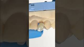 DoubleWinged Lateral Maryland Bridge EnvisiontecMain envisiontec lsk121shorts dentist [upl. by Iv]