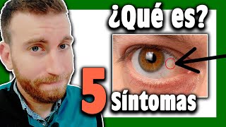 🟩 ¿Qué es la PINGUÉCULA en el ojo 👉 Causas y Síntomas Cap 1 [upl. by Anoblav]