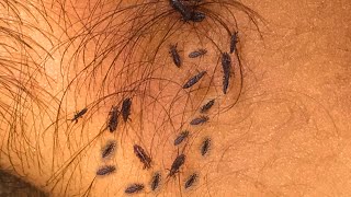 Nits picking Lice Picking Using Comb Lice Picking Long Hair 27 [upl. by Deena766]