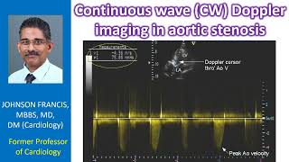 Continuous wave CW Doppler imaging in aortic stenosis [upl. by Ciryl]