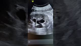 Hydronephrosis  renal ultrasound [upl. by Earley]