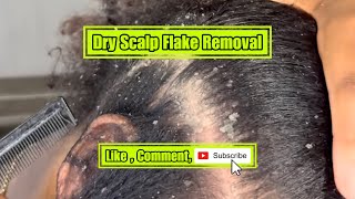 Dry scalp Flake removal [upl. by Amat]