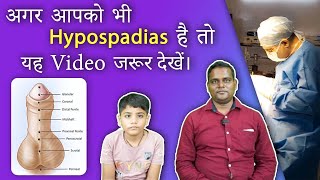 Successful Hypospadias Surgeon in Kolkata  मूत्र का छिद्र सही जगह पर न खुलने की समस्या  Dr Nagwani [upl. by Fattal]