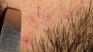 ingrown hair removal video pimplehairproblem recovery [upl. by Naraj]