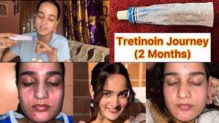 2 Month RetinolTretinoin Journey✨ [upl. by Nayd]