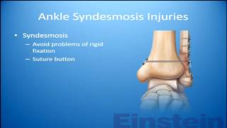 Any consensus on the syndesmosis An update [upl. by Yelrac29]