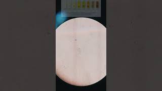 🎥Trichomoniasis Trichomonas in urine under 🎥📲Microscope Its Symptoms and sign With treatment [upl. by Kcirdehs617]