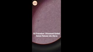 IUI procedure is much simpler than IVF [upl. by Nodyarb121]