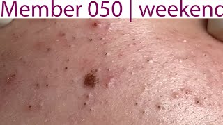 Acne Treatment Huong Da Nang 050  weekend  2023 [upl. by Yakcm366]