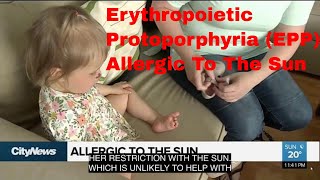 Rare Genetic Disease Makes Toddler Allergic To The Sun [upl. by Ardnaz]