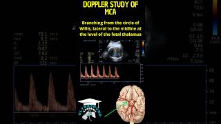 Quick Guide Doppler Ultrasound of the Fetal Middle Cerebral Artery [upl. by Allehc129]