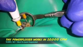 using power flosser waterpik with endoactivator tip to agitate endodontic irrigating solution [upl. by Kirimia]