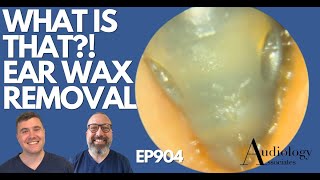 WHAT IS THAT EAR WAX REMOVAL  EP904 [upl. by Adnolay]