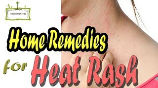 Home Remedies for Heat Rash  Treat Heat Rash prickly at home  Cure Heat Rash prickly  Heat Rash [upl. by Llevad256]