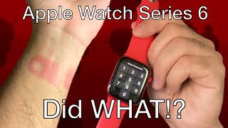 My Apple Watch Series 6 BURNED Me [upl. by Livvyy976]