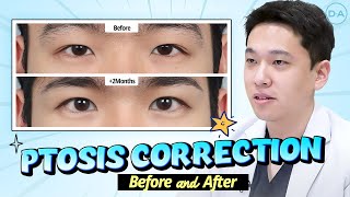 Plastic Surgery Korea Ptosis Correction Before amp After [upl. by Daj190]